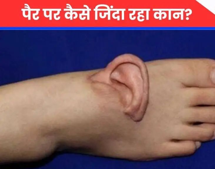 🤯 ‘Miracle’ Surgery: ਕੱਟਿਆ ਕੰਨ ਪੈਰ ‘ਤੇ ਜੋੜਿਆ, 5 ਮਹੀਨੇ ਬਾਅਦ Head ‘ਤੇ Reattach!